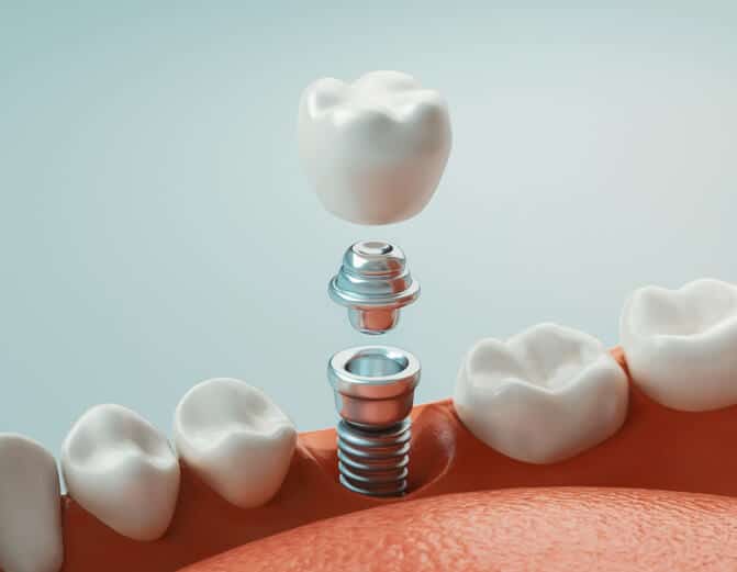 types of dental implants materials