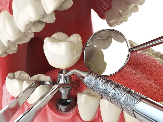 dental implants bone grafting procedure