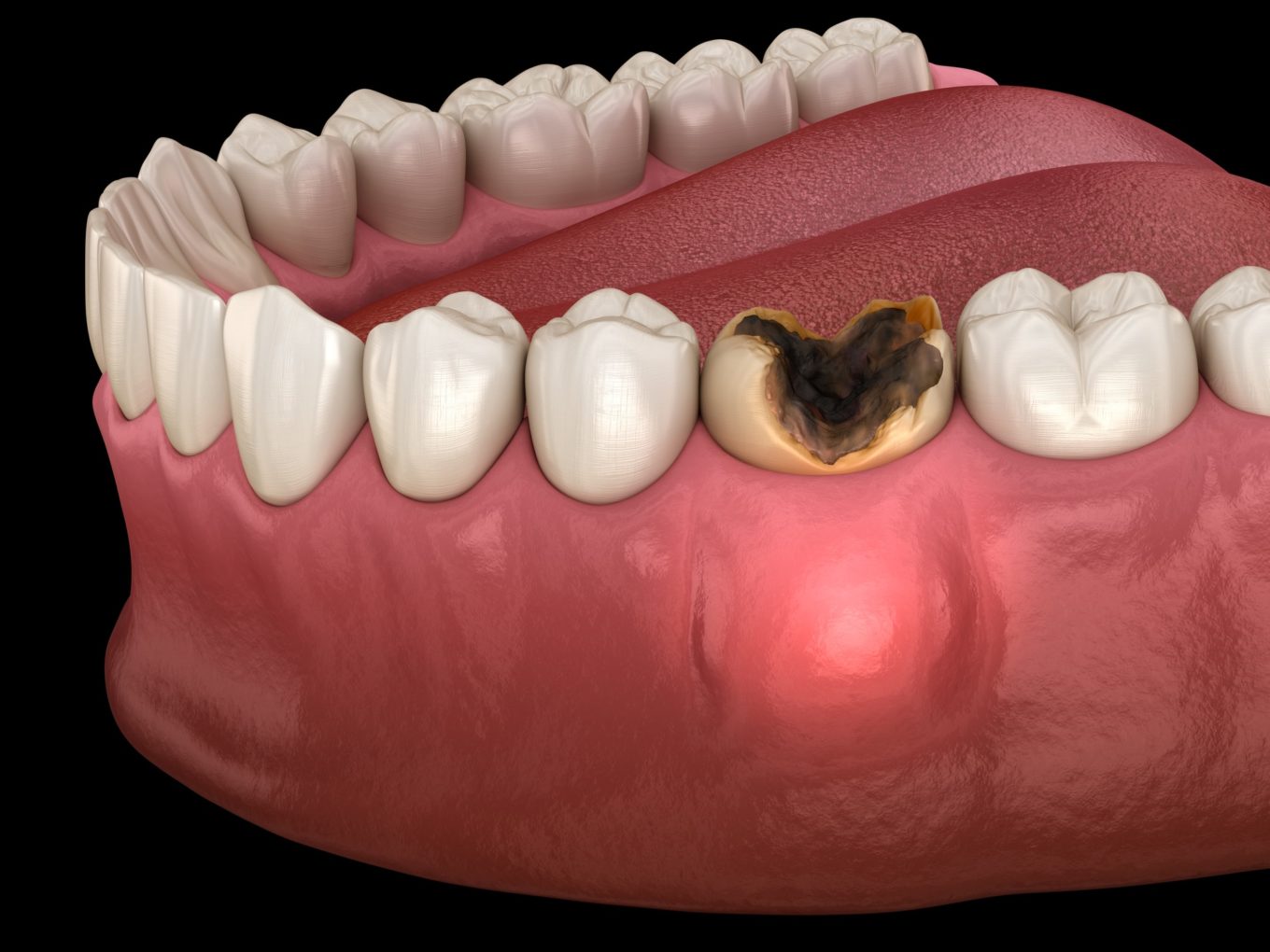 dead tooth root canal before and after