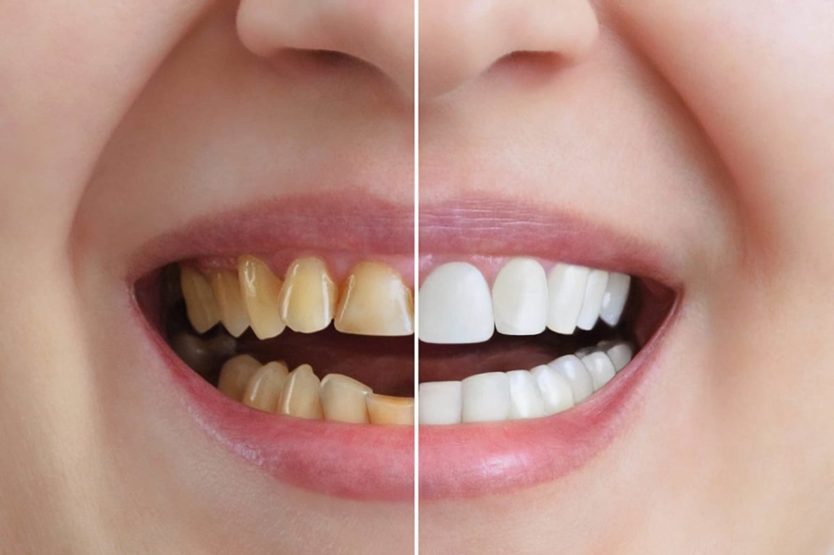teeth whitening before and after