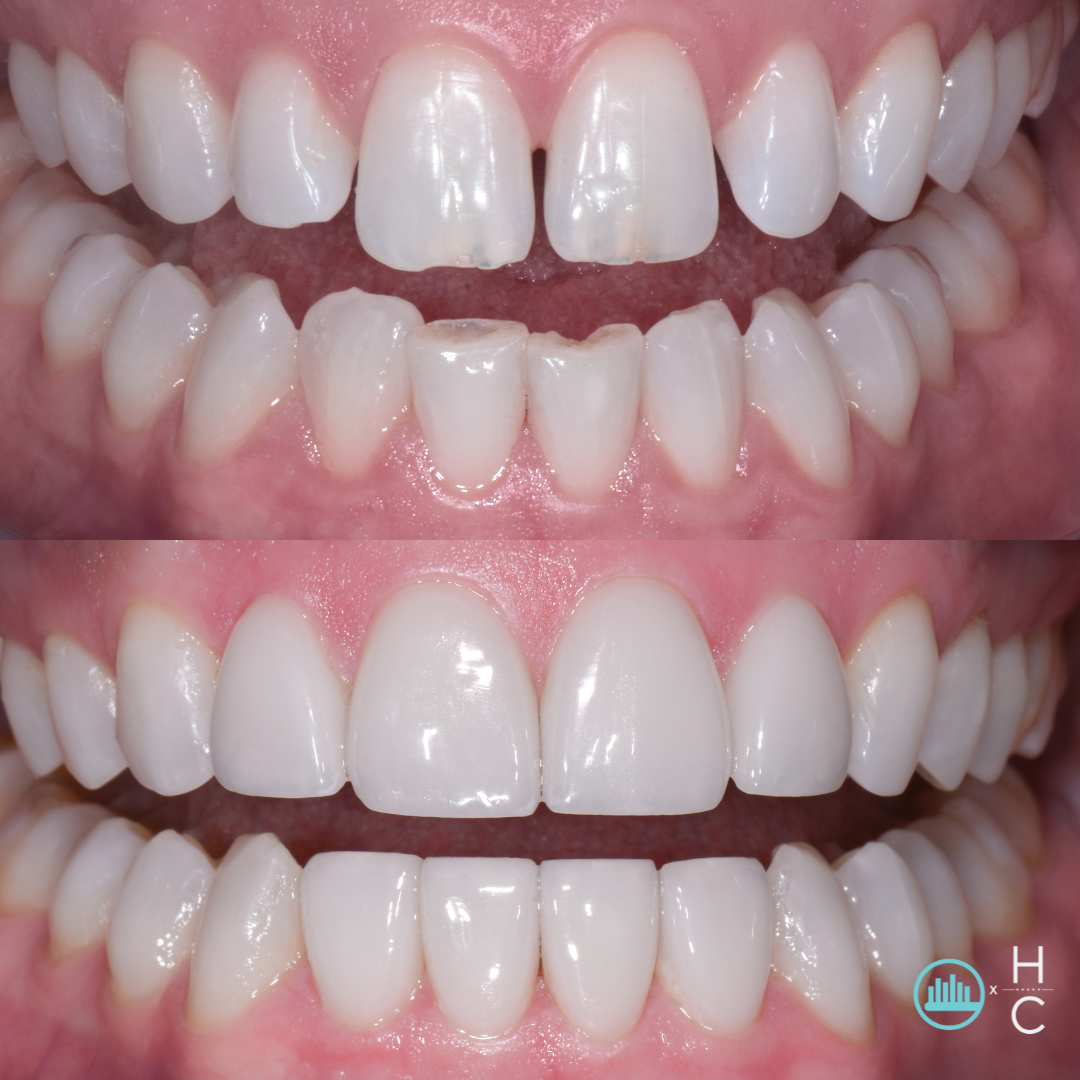 Custom veneers