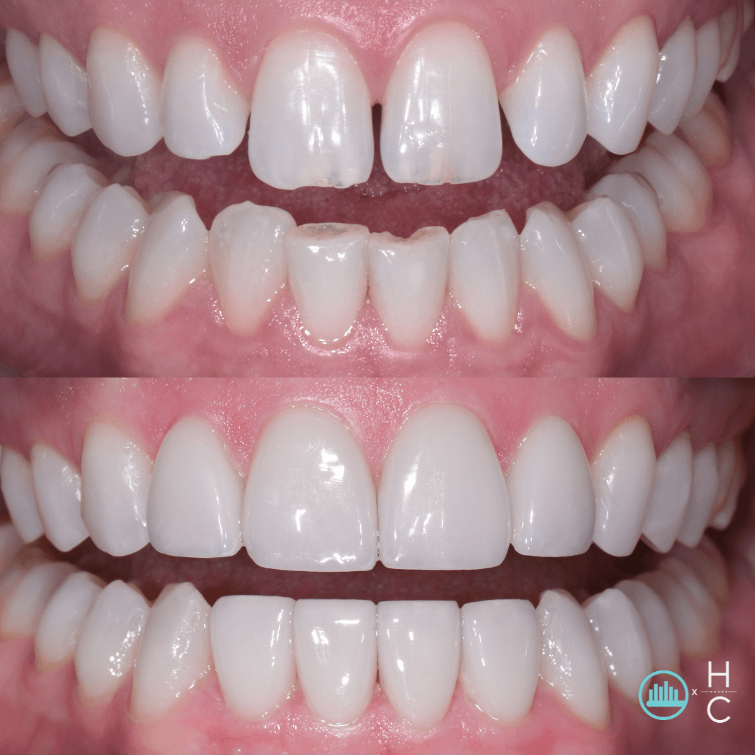 how to get rid of overbite