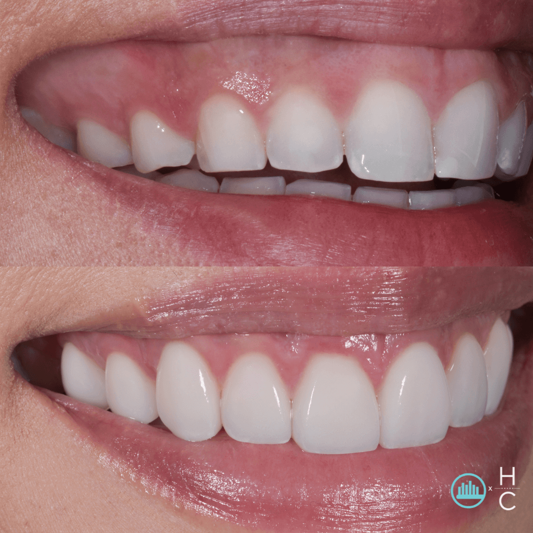 how to fix gummy smile